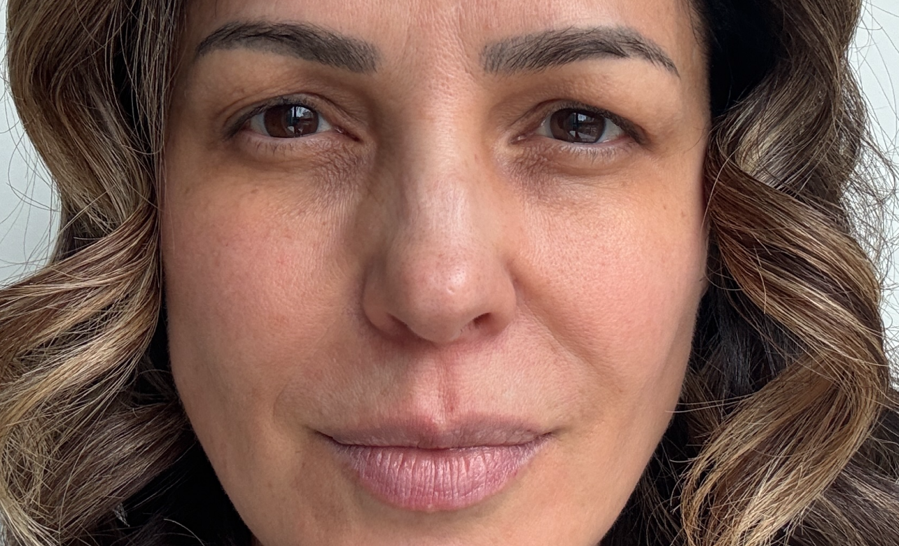 Blepharoplasty Before