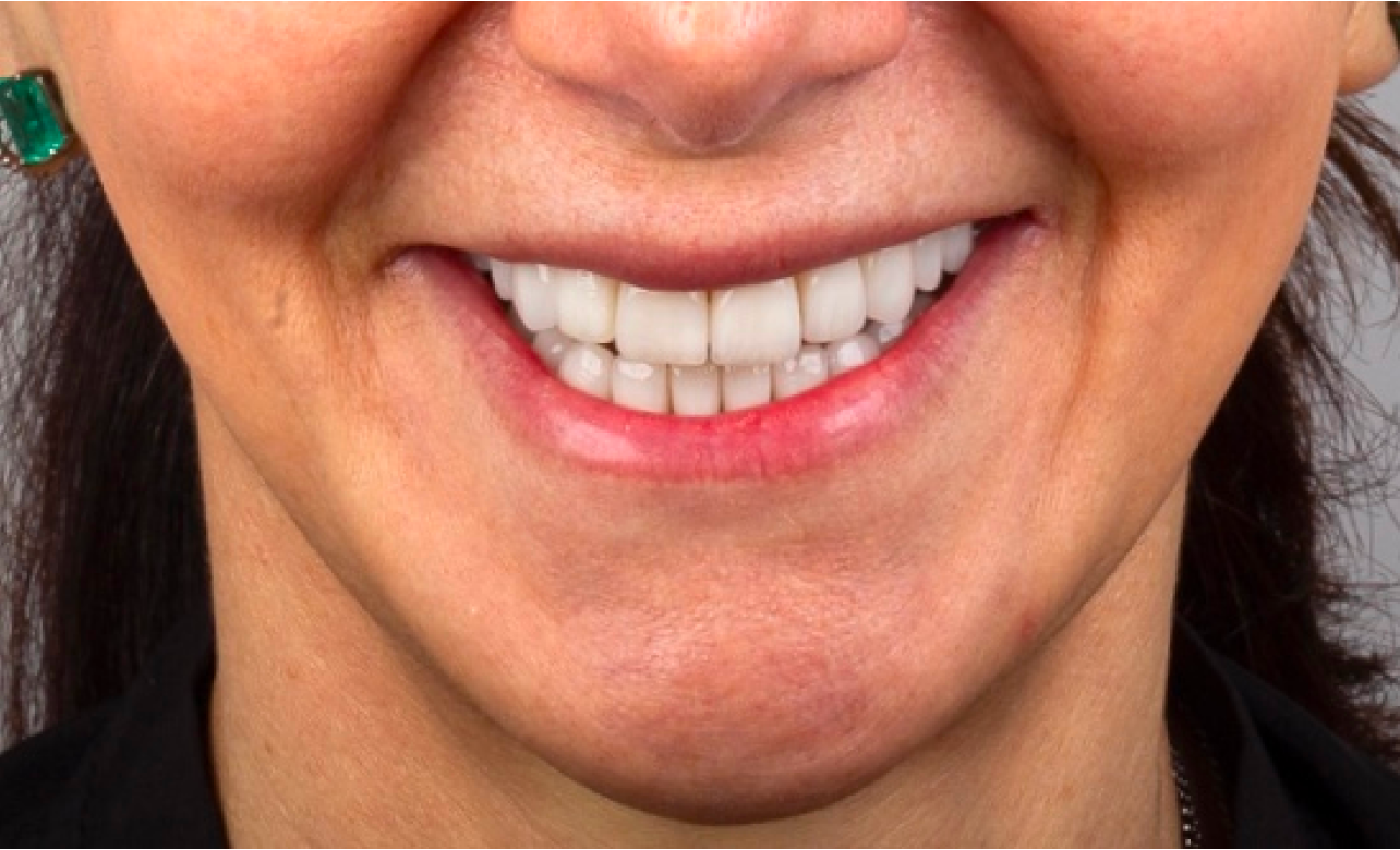 Dental Veneers 3 after