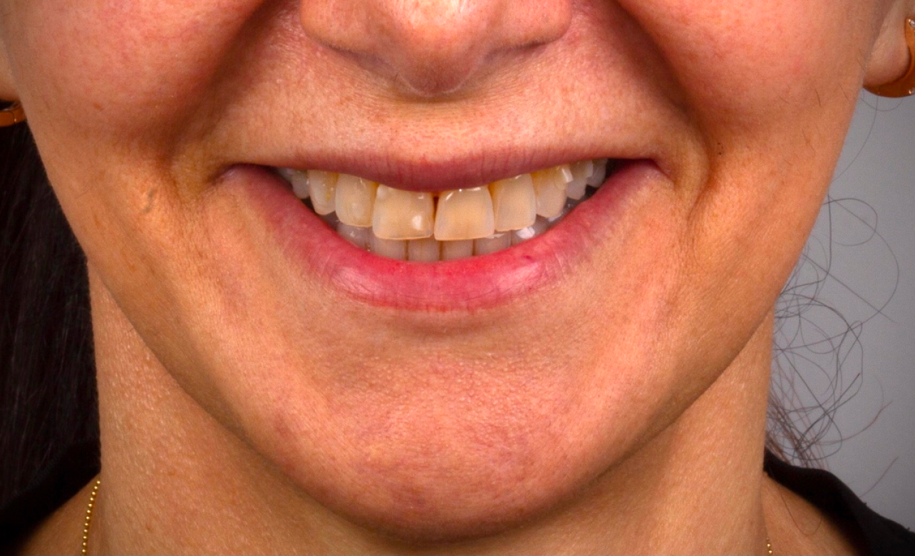 Dental Veneers 3 before