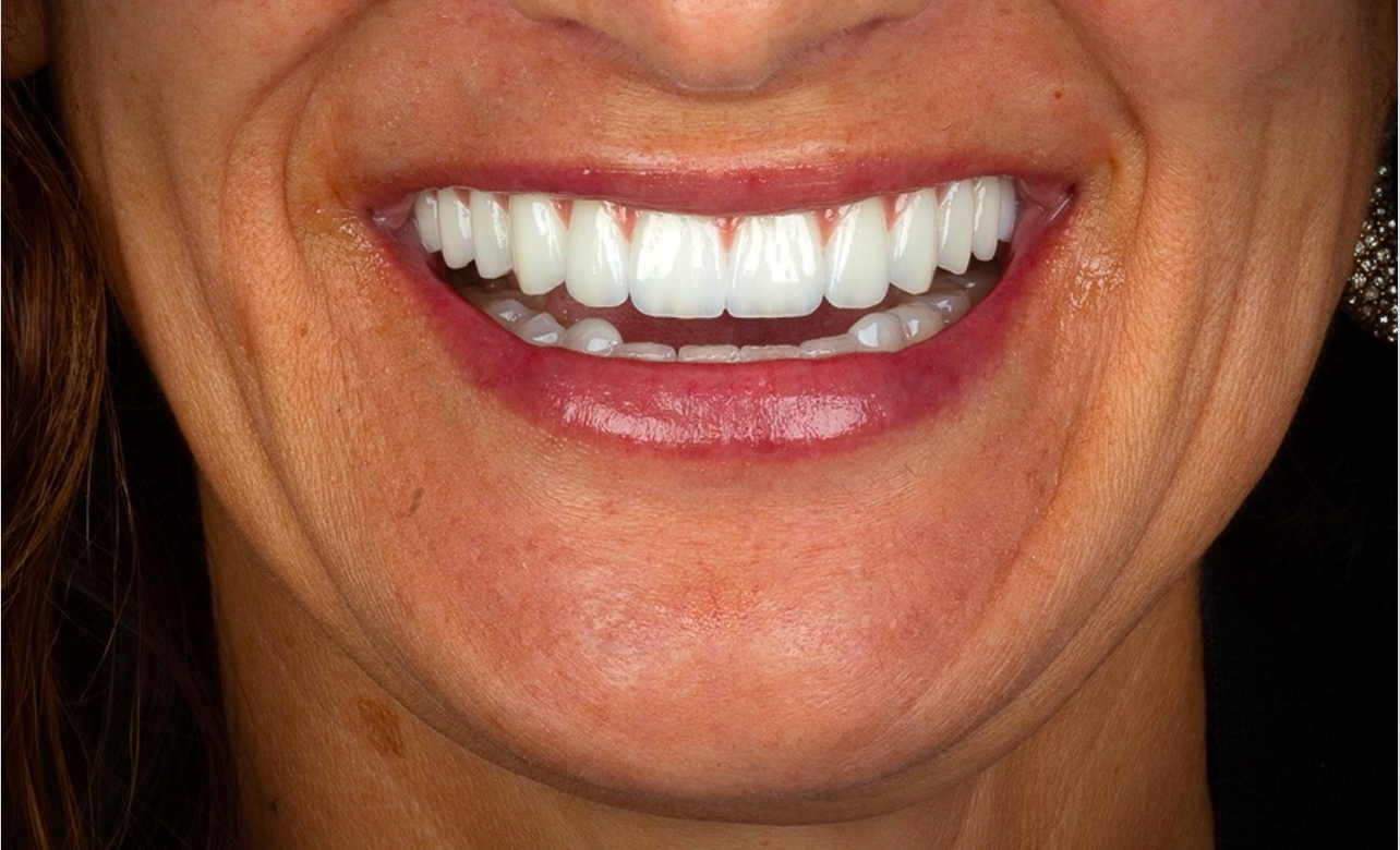 Feldspathic Porcelain 1 after