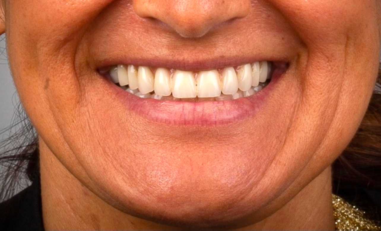 Feldspathic Porcelain 1 before