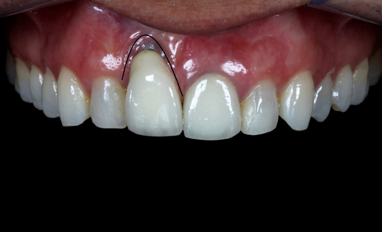 Gum Surgery 1 before