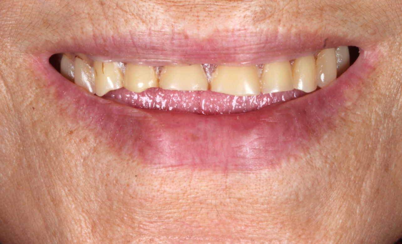 Resin Veneers 1 before