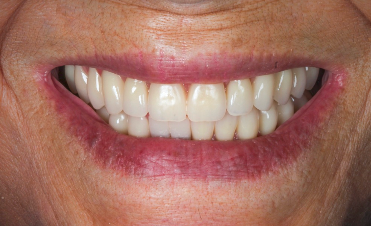 Resin Veneers 2 after