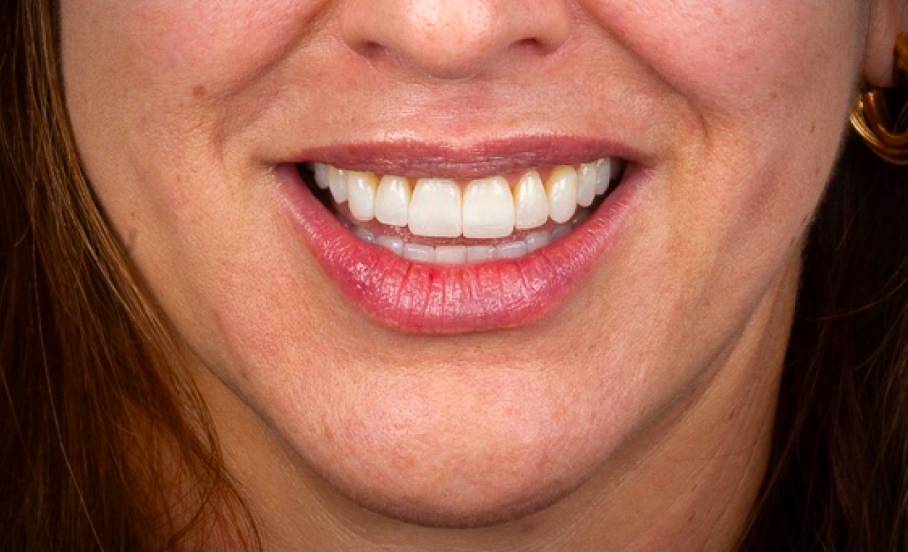 Teeth Whitening After 1