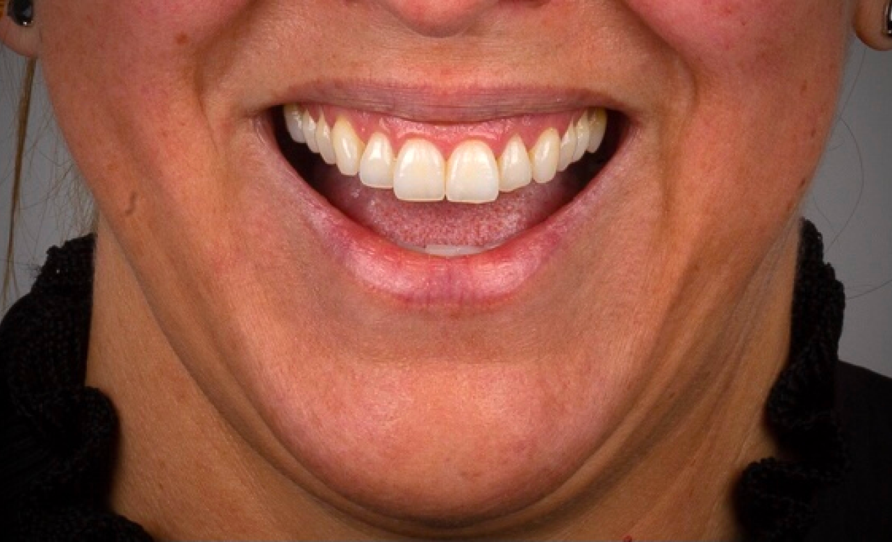 Teeth Whitening Before 1