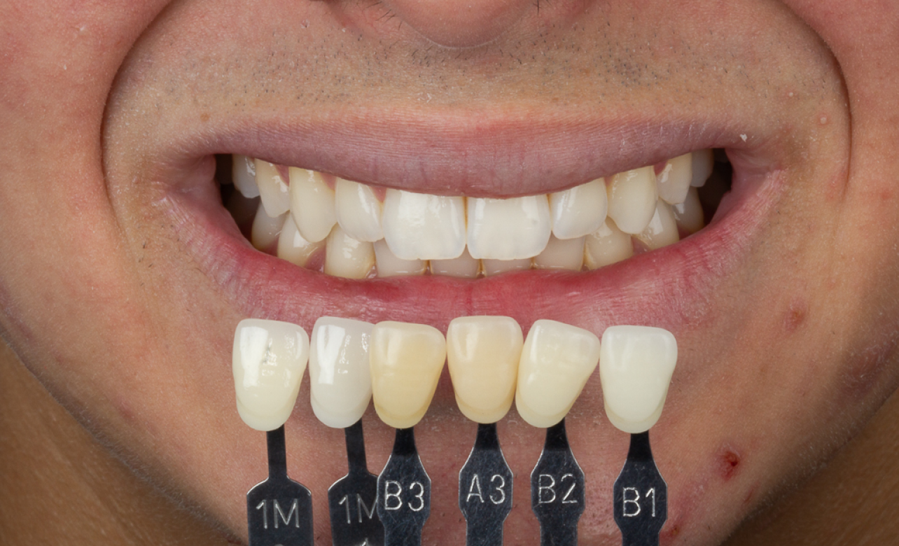 Teeth Whitening after 2