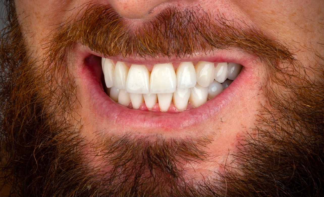 Dental Veneers after 4