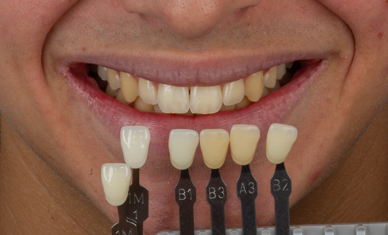 Teeth Whitening before 2