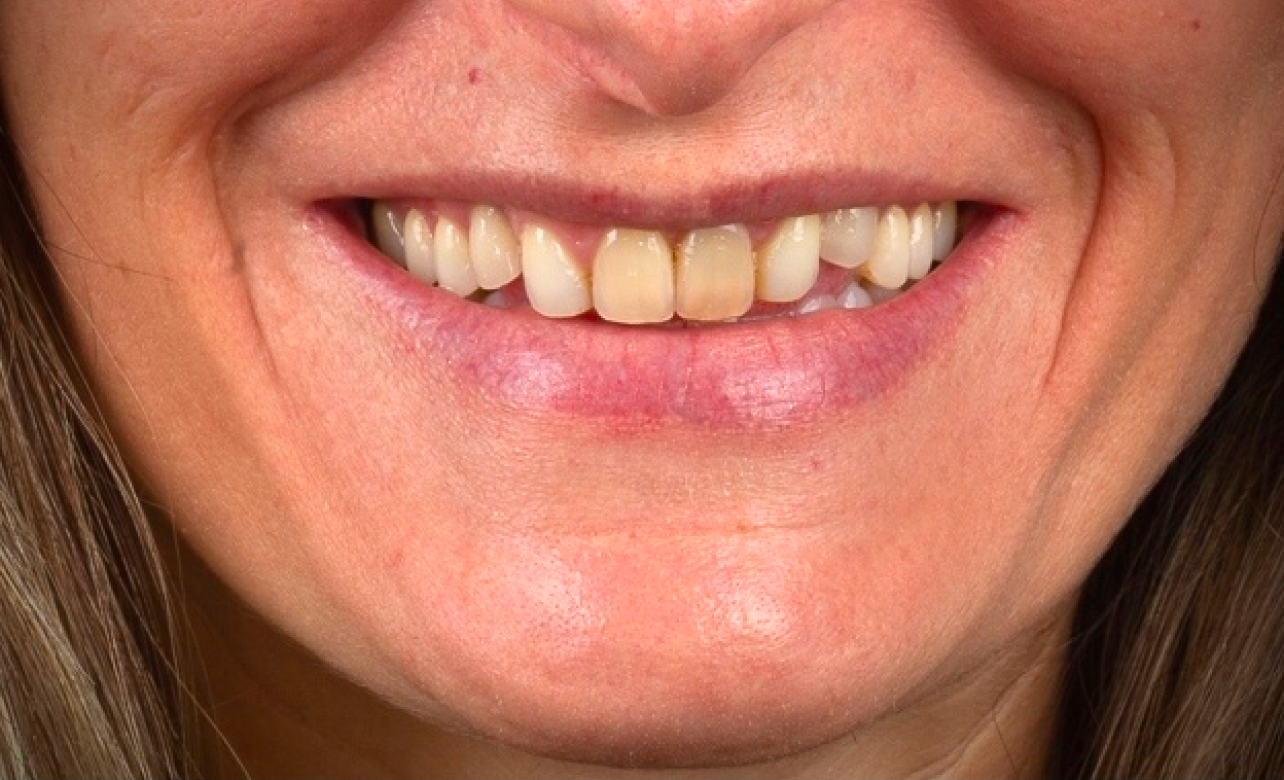 Dental Veneers before 3