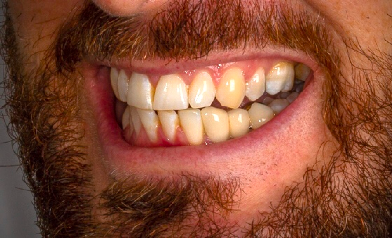 Dental Veneers before 4